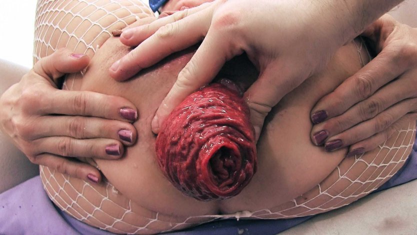 Экстремальный пролапс