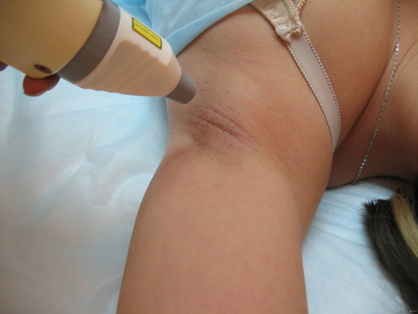 Лазерная эпиляция писечки