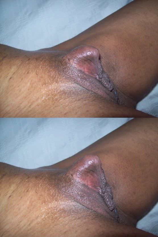 Варикоз половых губ фото