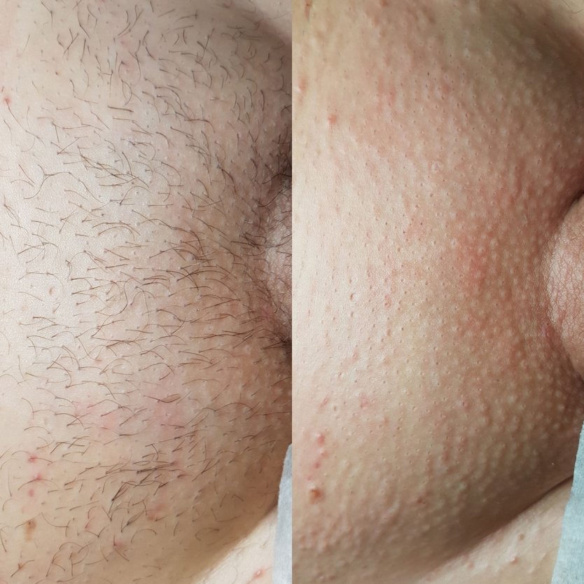 Интимная депиляция у мужчин