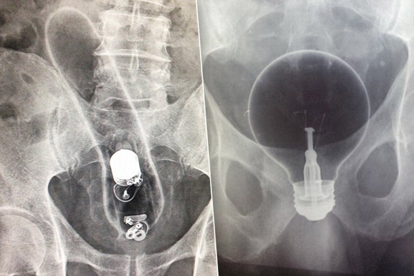 Необычные предметы во влагалище