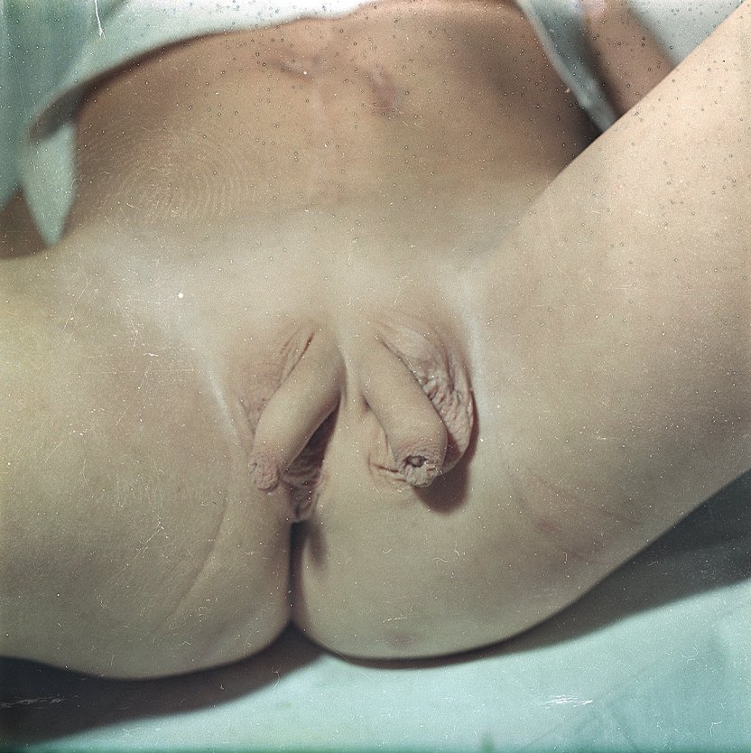 Необычные половые органы у женщин