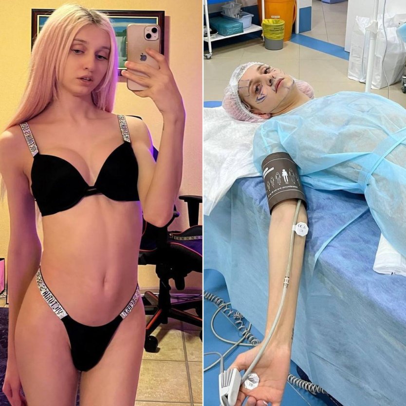 Вагинопластика фото до и после