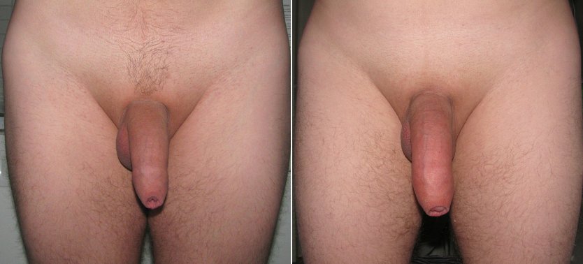 Обрезанный член в спокойном состоянии